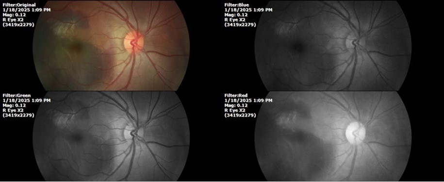 The location of the bleeding is mainly subretinal, although blood is seen in minimal quantity in the vitreous body.