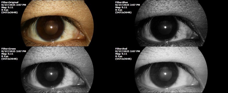 The photograph of the right eye shows an almost normal mirror reflection, as well as a better pupillary dilation.