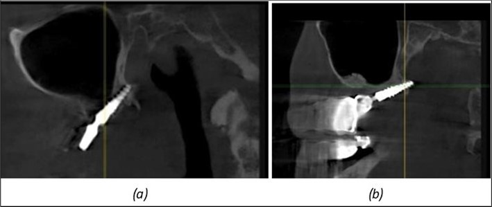 Implants in the pterygoid plateau area: (a) TPG implant fixed in the maxillary-sphenoid junction area, quadrant 1; (b) TPG implant fixed in the maxillary-sphenoid junction area, quadrant 2.