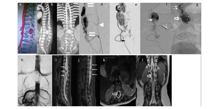 Journal of Neurological Research And Therapy-Perimedullary
